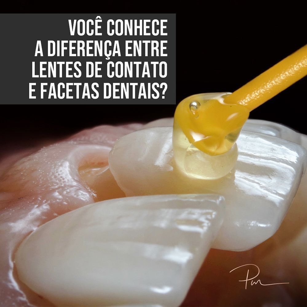 Você conhece as diferenças entre lentes de contato e facetas dentais?